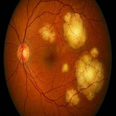 Secondary & Metastatic Eye Cancers